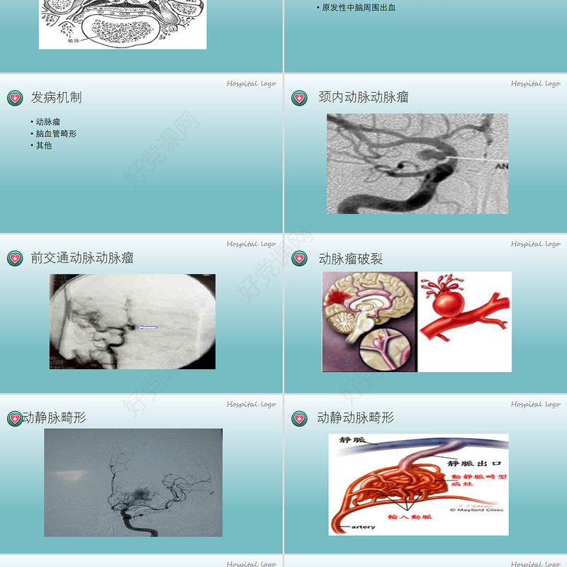 2022蛛网膜下腔出血PPT创意简约医疗教学各种疾病医理PPT模板