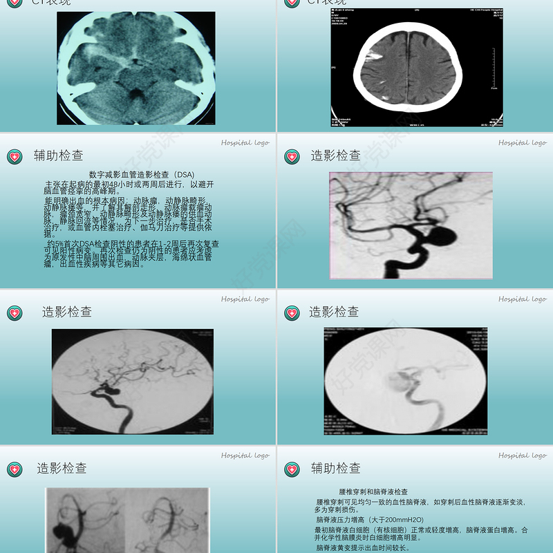 2022蛛网膜下腔出血PPT创意简约医疗教学各种疾病医理PPT模板